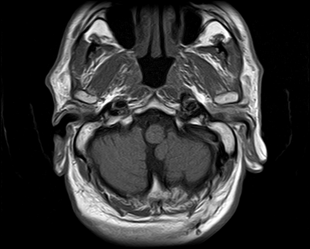 File:Non-Hodgkin lymphoma - parotid gland (Radiopaedia 71531-81890 Axial T1 19).jpg