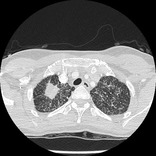 File:Non-small cell lung cancer with miliary metastases (Radiopaedia 23995-24193 Axial lung window 6).jpg