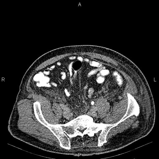 Non Hodgkin lymphoma in a patient with ankylosing spondylitis (Radiopaedia 84323-99621 Axial C+ delayed 58).jpg