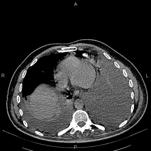 File:Non Hodgkin lymphoma in a patient with ankylosing spondylitis (Radiopaedia 84323-99621 Axial non-contrast 22).jpg