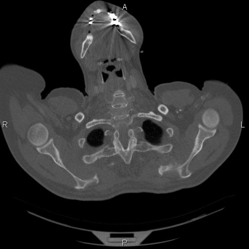 Non Hodgkin lymphoma in a patient with ankylosing spondylitis (Radiopaedia 84323-99624 Axial bone window 3).jpg