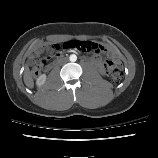 File:Normal CT angiogram of pelvis (Radiopaedia 45390-49430 A 2).jpg