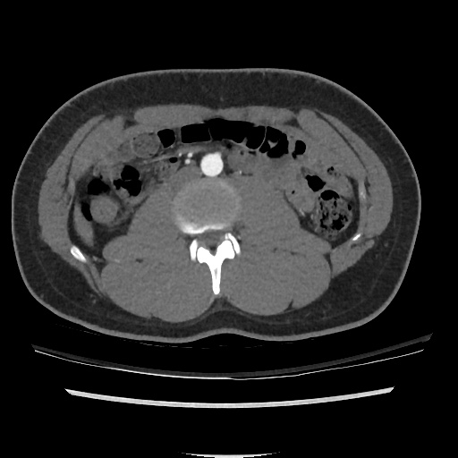 File:Normal CT angiogram of pelvis (Radiopaedia 45390-49430 A 4).jpg