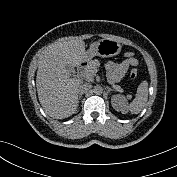 Normal CT chest- adult female (Radiopaedia 52522-58428 Axial non-contrast 139).jpg