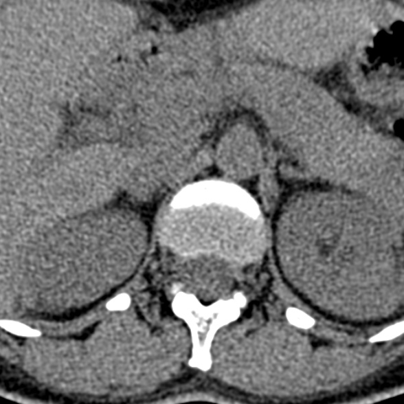 Normal CT lumbar spine (Radiopaedia 53981-60118 Axial non-contrast 10).jpg
