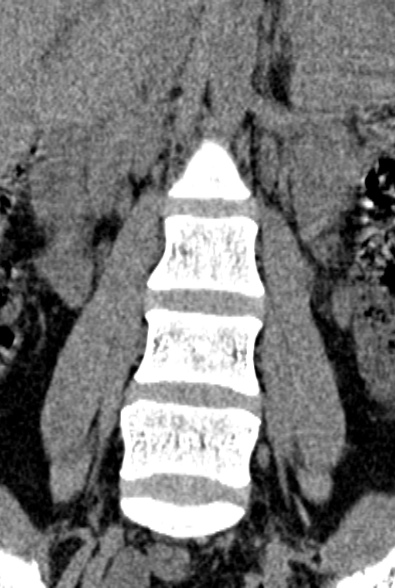 Normal CT lumbar spine (Radiopaedia 53981-60118 F 24).jpg