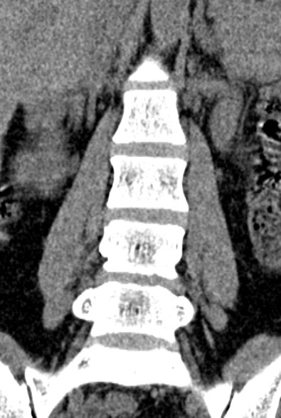 Normal CT lumbar spine (Radiopaedia 53981-60118 F 31).jpg