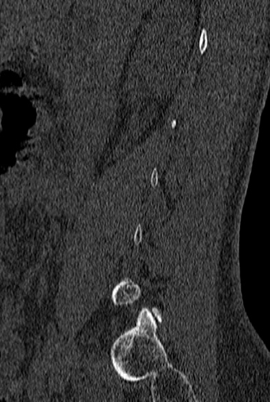 File:Normal CT lumbar spine (Radiopaedia 53981-60118 Sagittal bone window 13).jpg