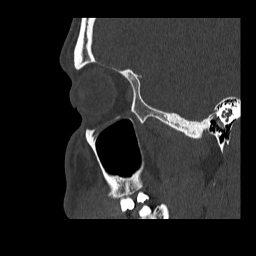 Normal CT paranasal sinuses (Radiopaedia 42286-45390 Sagittal bone window 83).jpg