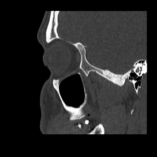 Normal CT paranasal sinuses (Radiopaedia 42286-45390 Sagittal bone window 84).jpg