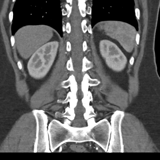 File:Normal CT renal artery angiogram (Radiopaedia 38727-40889 B 58).png