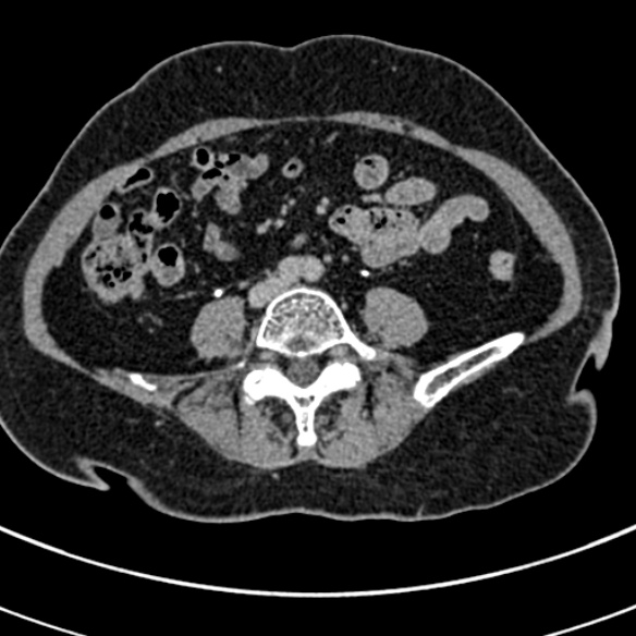 File:Normal CT split bolus study of the renal tract (Radiopaedia 48631-53634 Axial split bolus 169).jpg