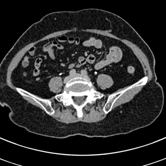 File:Normal CT split bolus study of the renal tract (Radiopaedia 48631-53634 Axial split bolus 185).jpg