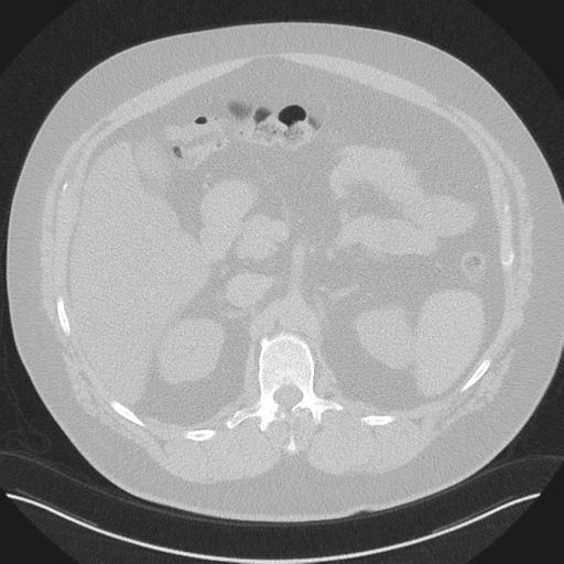 Normal HRCT (Radiopaedia 40797-43458 Axial lung window 65).png