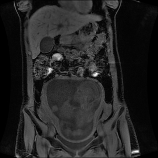 Normal MRI abdomen in pregnancy (Radiopaedia 88001-104541 M 54).jpg
