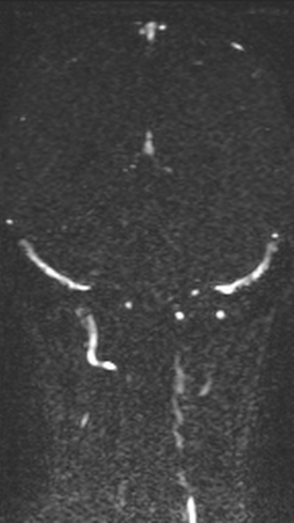 Normal MRI brain with MRV- teenager (Radiopaedia 49425-54553 Coronal MRV 164).jpg