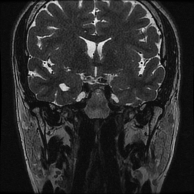 Normal MRI petrous (Radiopaedia 91317-108949 Coronal T2 11).jpg