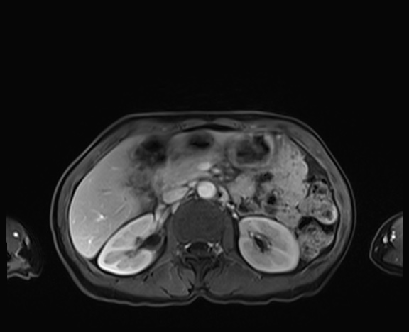 Normal adrenal glands MRI (Radiopaedia 82017-96004 K 37).jpg