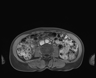 Normal adrenal glands MRI (Radiopaedia 82017-96004 M 60).jpg