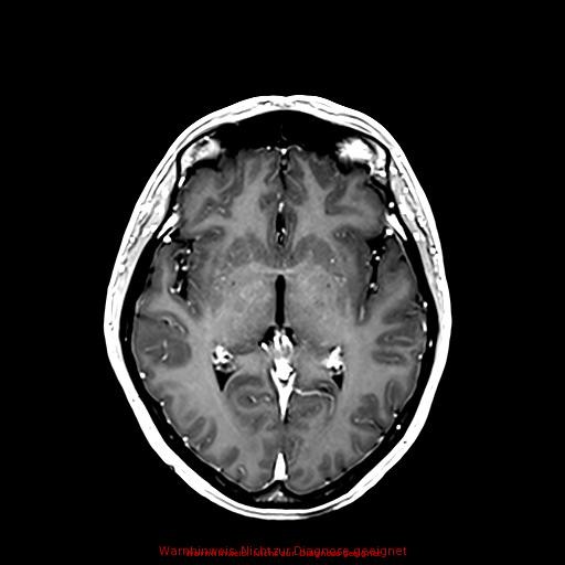 Normal adult brain MRI (non-enhanced and contrast-enhanced) (Radiopaedia 75262-86379 Axial T1 C+ 102).jpg
