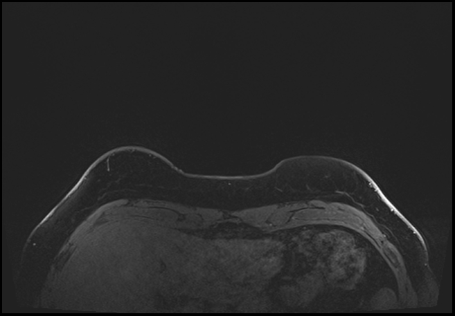 Normal breast MRI - dense breasts (Radiopaedia 80454-93850 C 12).jpg