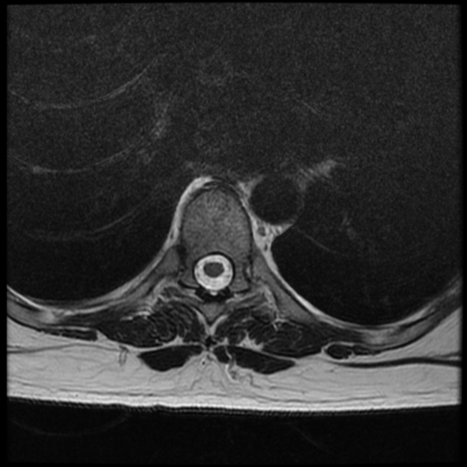 File:Normal cervical and thoracic spine MRI (Radiopaedia 35630-37156 H 23).png
