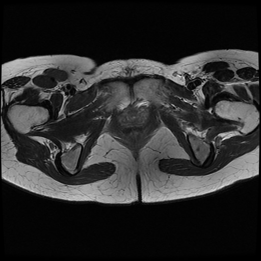 File:Normal female pelvis MRI (retroverted uterus) (Radiopaedia 61832-69933 Axial T2 26).jpg
