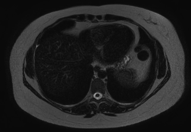 File:Normal liver MRI with Gadolinium (Radiopaedia 58913-66163 E 29).jpg