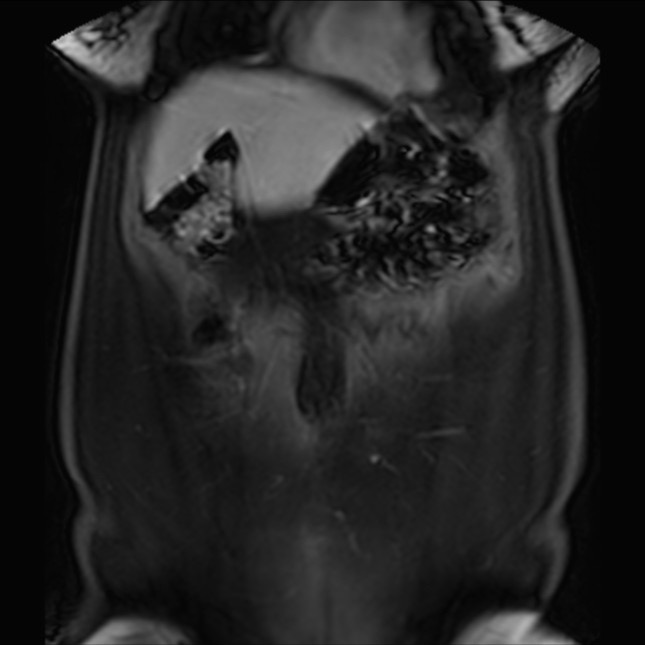 Normal liver MRI with Gadolinium (Radiopaedia 58913-66163 P 19).jpg