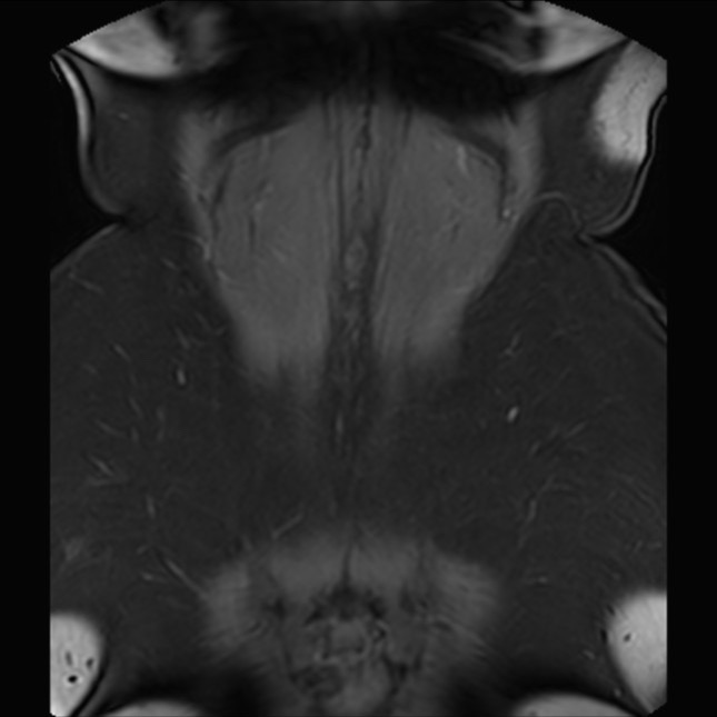 Normal liver MRI with Gadolinium (Radiopaedia 58913-66163 P 80).jpg