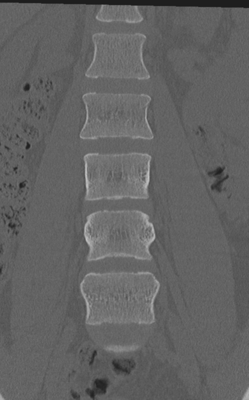 Normal lumbar spine CT (Radiopaedia 46533-50986 Coronal bone window 29).png