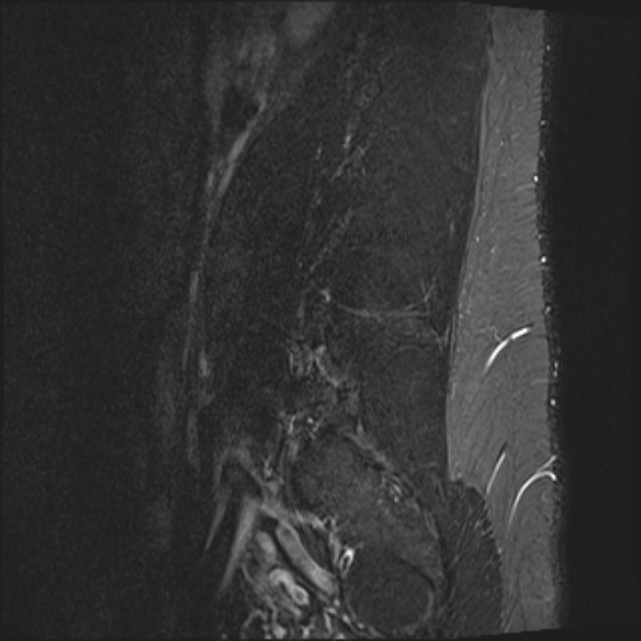 File:Normal lumbar spine MRI (Radiopaedia 47857-52609 Sagittal STIR 19).jpg