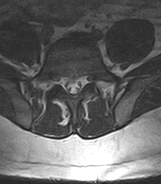 Normal lumbar spine MRI - low-field MRI scanner (Radiopaedia 40976-43699 Axial T2 82).jpg