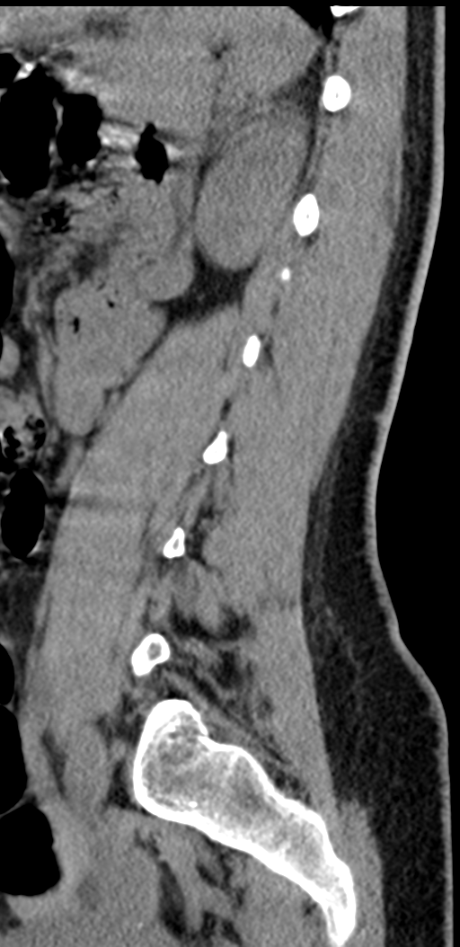 Normal lumbosacral CT (Radiopaedia 37923-39867 E 35).png