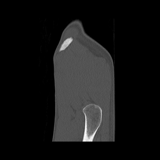 Normal pelvis (Radiopaedia 51473-57238 Sagittal bone window 10).jpg