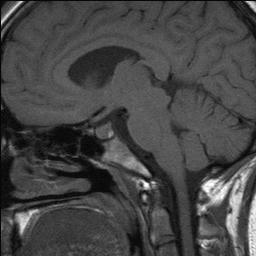 File:Normal posterior pituitary bright spot (Radiopaedia 6128).jpg