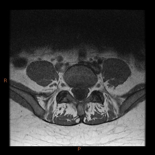 File:Normal spine MRI (Radiopaedia 77323-89408 Axial T1 22).jpg