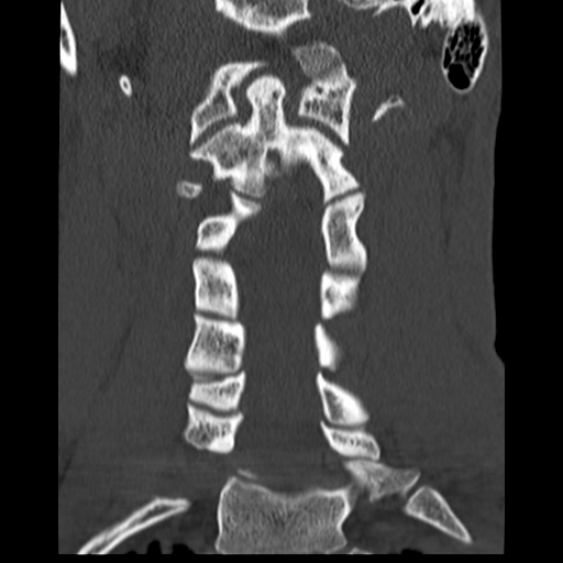 File:Normal trauma cervical spine (Radiopaedia 41017-43760 Coronal bone window 19).png