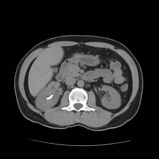 File:Obstructed kidney with perinephric urinoma (Radiopaedia 26889-27067 Axial non-contrast 9).jpg