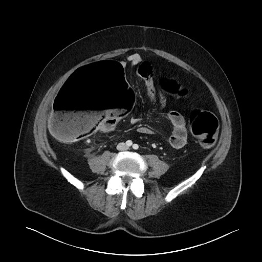 File:Obstructing sigmoid adenocarcinoma (Radiopaedia 58465-65619 A 105).jpg