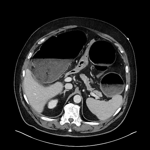 File:Obstructing sigmoid adenocarcinoma (Radiopaedia 58465-65619 A 46).jpg
