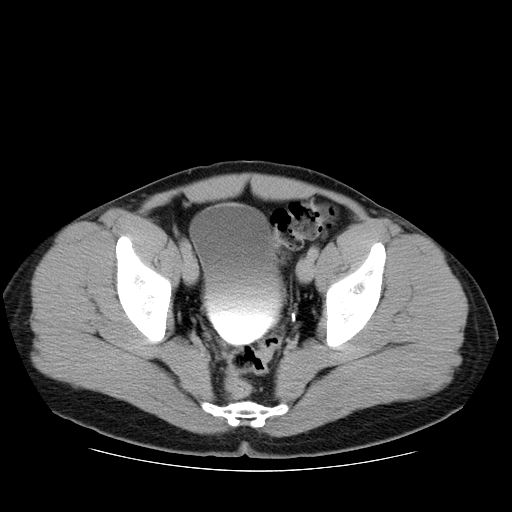 Obstructing ureteric calculus (Radiopaedia 18615-18514 D 49).jpg