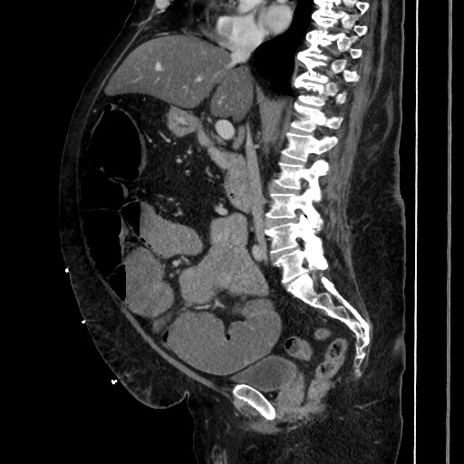 Obstructive colonic diverticular stricture (Radiopaedia 81085-94675 C 116).jpg