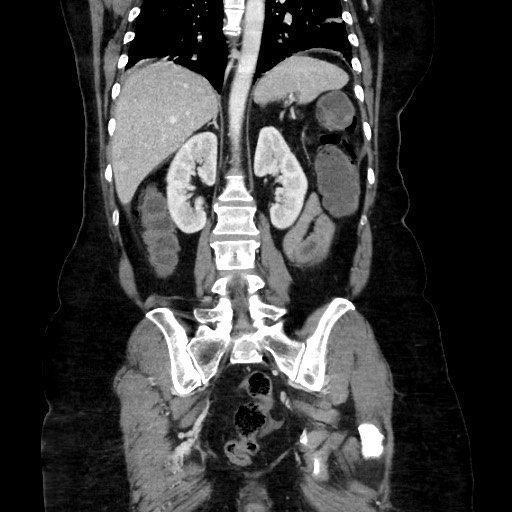 Obstructive distal colonic adenocarcinoma causing cecal perforation (Radiopaedia 86830-102989 C 121).jpg