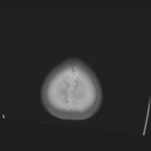 File:Obstructive hydrocephalus (Radiopaedia 30453-31119 Axial bone window 2).jpg