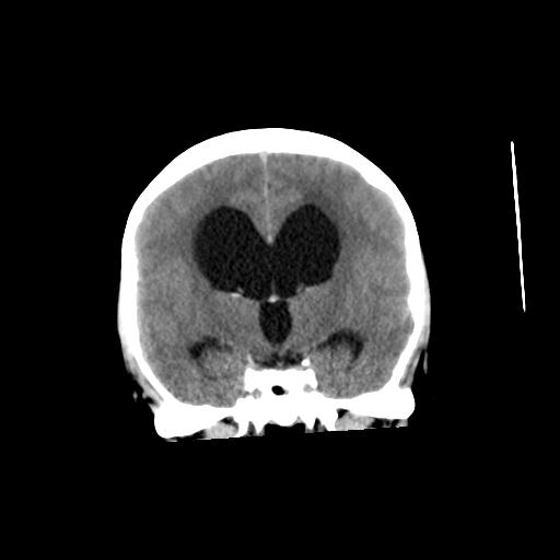 File:Obstructive hydrocephalus (Radiopaedia 30453-31119 Axial non-contrast 1).jpg