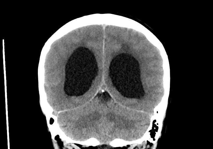 File:Obstructive hydrocephalus (Radiopaedia 30453-31119 Coronal non-contrast 28).jpg