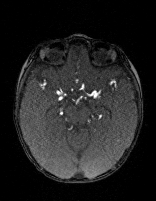 Occipital horn syndrome (Radiopaedia 14255-14129 MRA 66).jpg