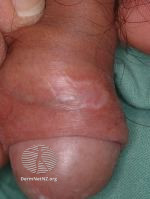 File:Penile lichen sclerosus (DermNet NZ 088-small).jpg