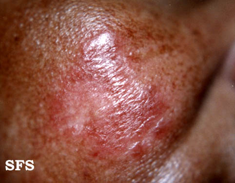 File:Sarcoidosis (Dermatology Atlas 2).jpg